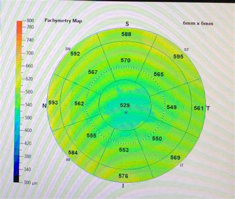 measuring corneal thickness|thin cornea thickness chart.